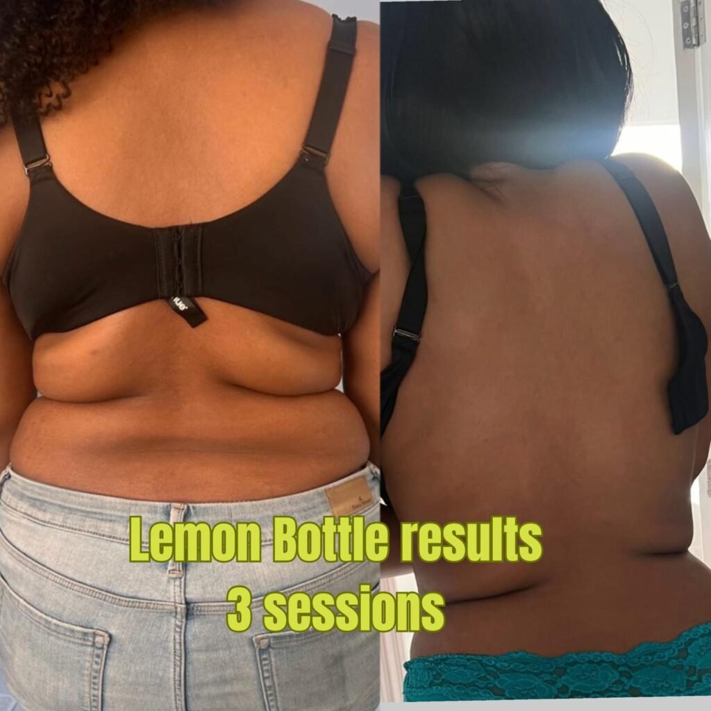 Lemon Bottle Fat Dissolving