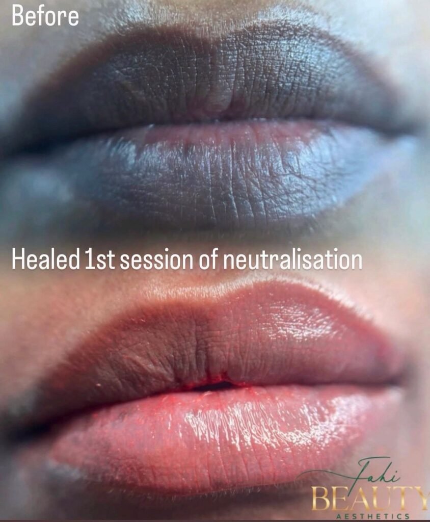 Lip Neutralisation